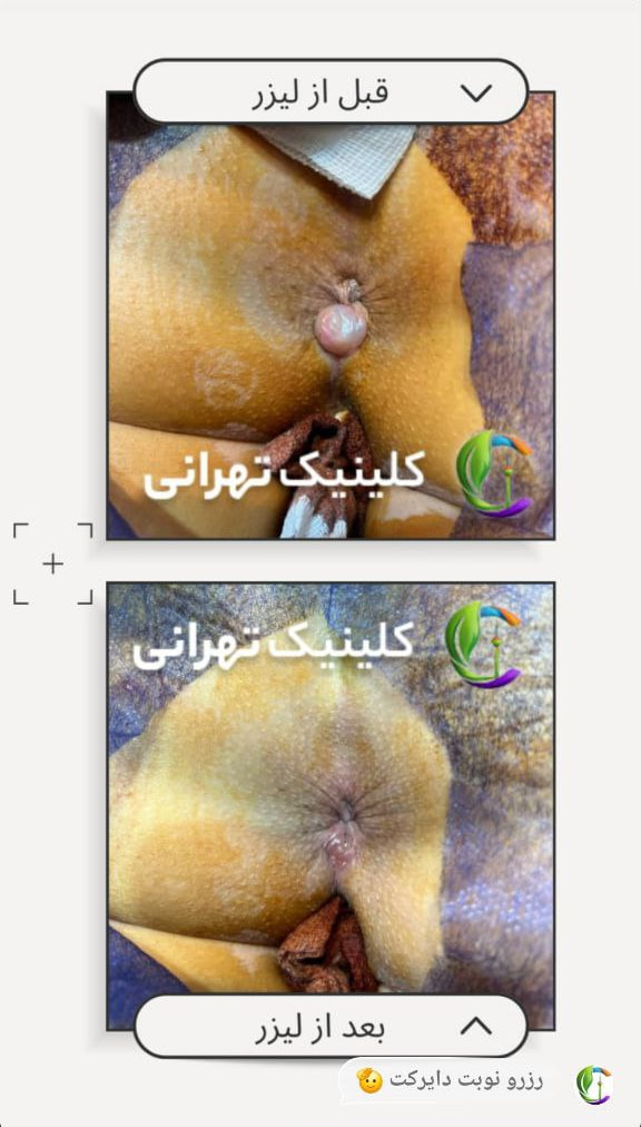عکس قبل و بعد از لیزر بواسیر