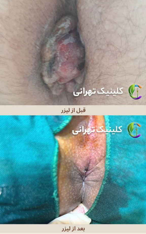 قبل و بعد از درمان بواسیر خارجی با لیزر