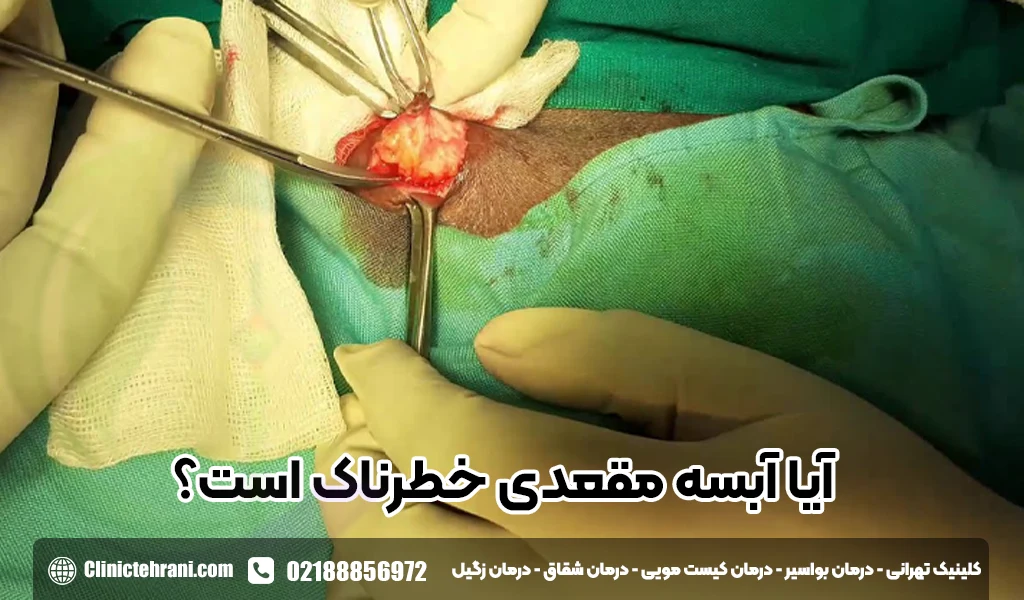 آیا آبسه مقعدی خطرناک است؟