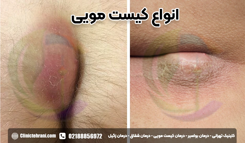 انواع کیست مویی