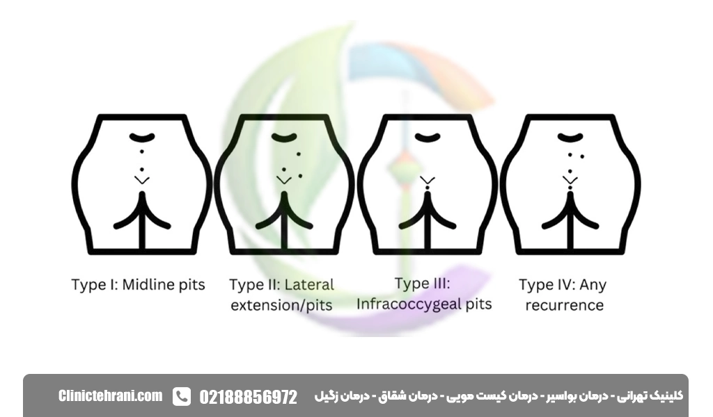 انواع کیست مویی