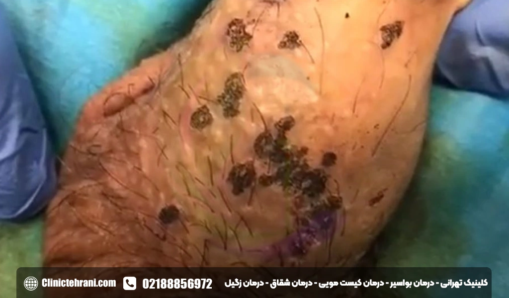 بعد از سوزاندن زگیل