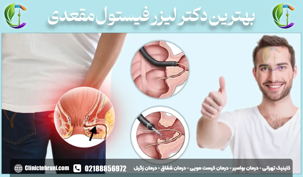 بهترین دکتر لیزر فیستول مقعدی