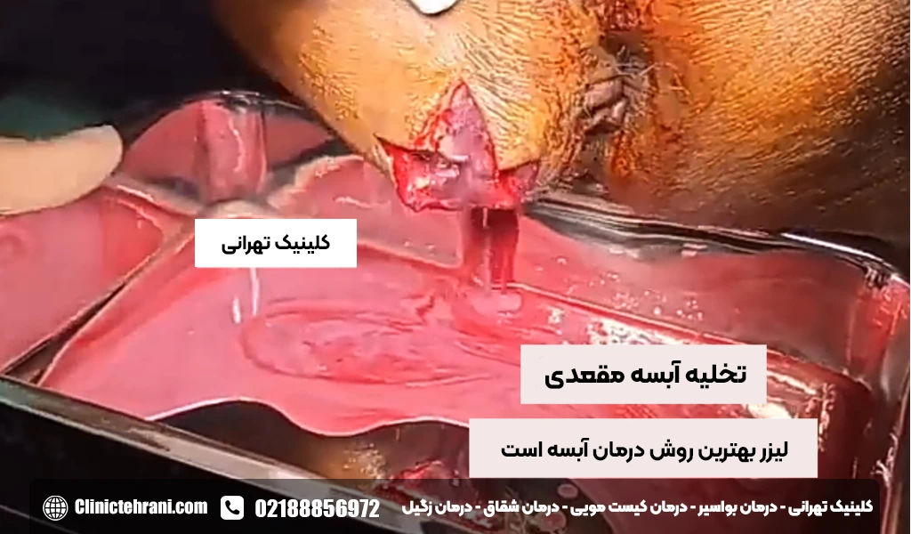 بهترین راه درمان آبسه مقعدی