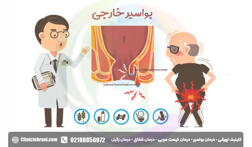 بواسیر خارجی