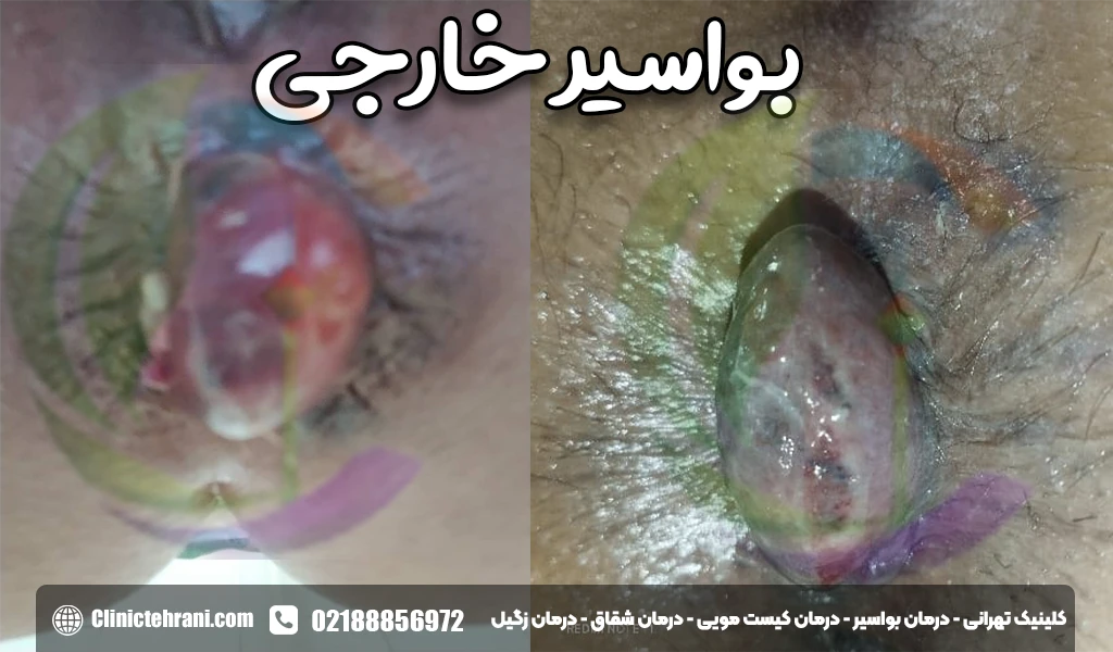بواسیر یا هموروئید خارجی