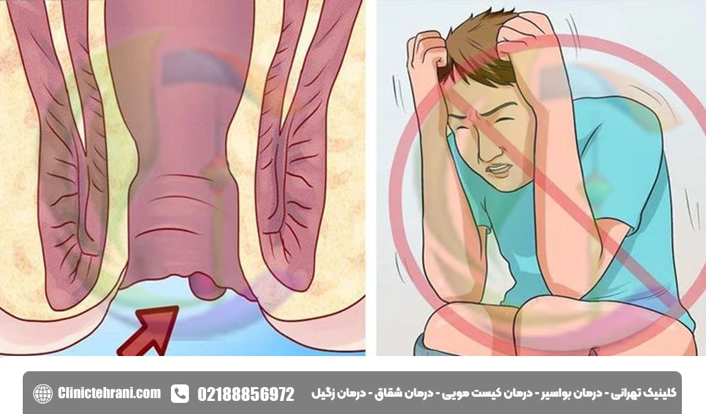 هموروئید چیست