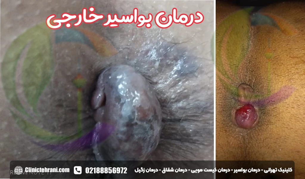 درمان بواسیر خارجی