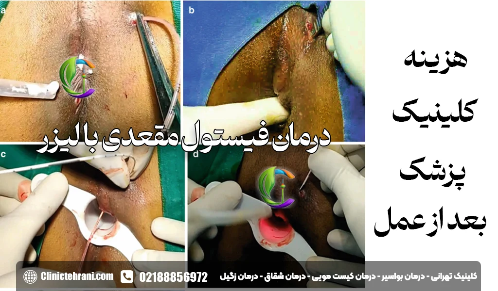 درمان فیستول مقعدی با لیزر