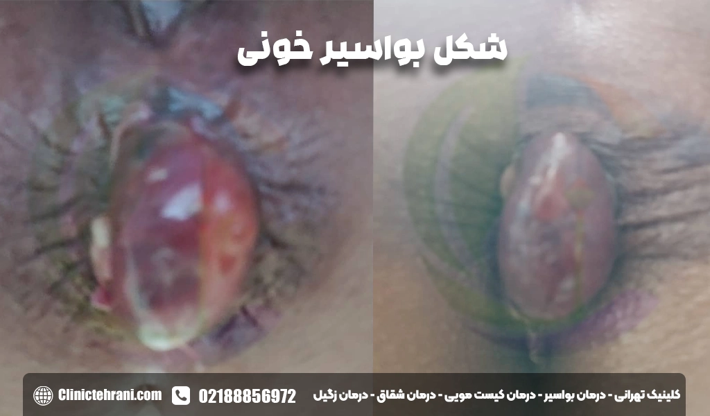 شکل بواسیر خونی