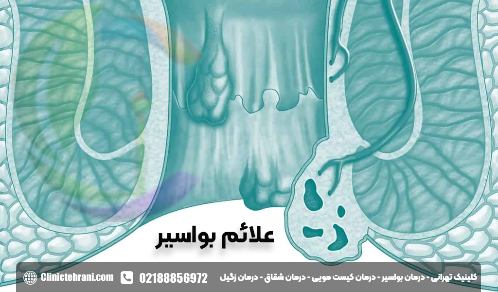 علائم بواسیر