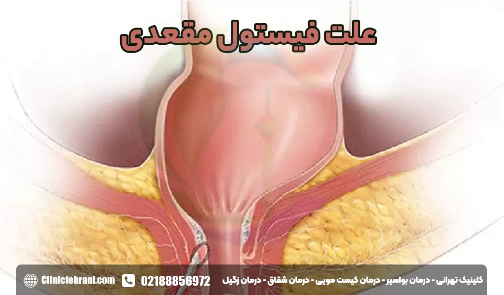 علت فیستول مقعدی