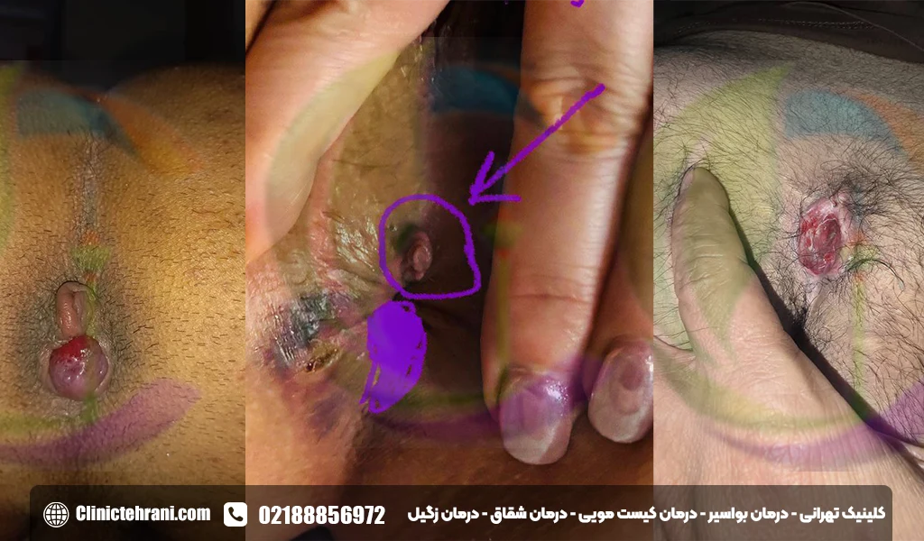 عکس بواسیر و هموروئید