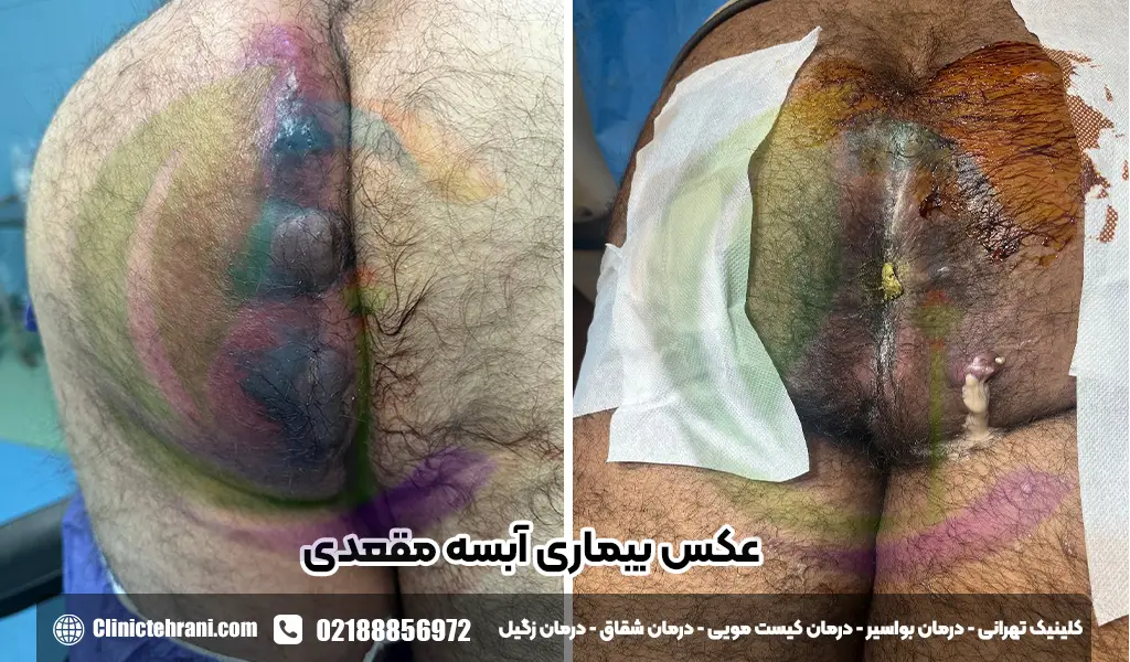عکس بیماری آبسه مقعدی