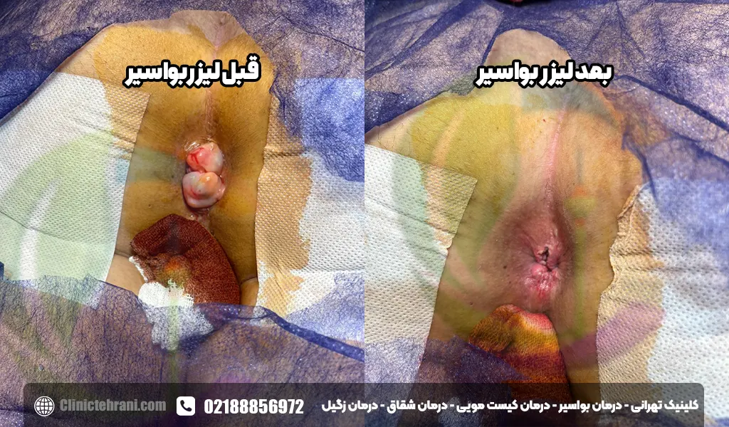 عکس قبل و بعد از عمل بواسیر