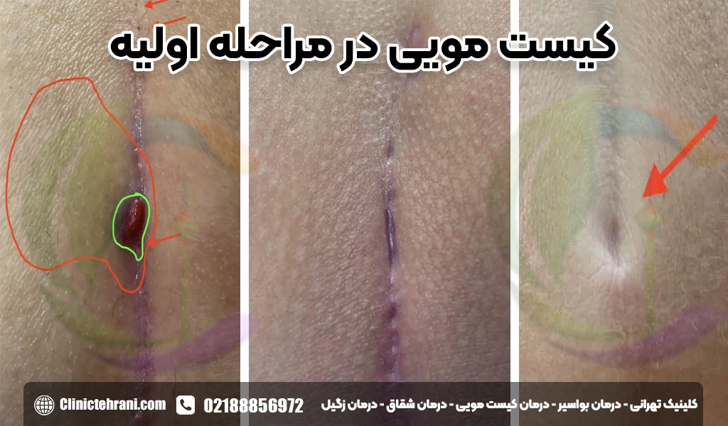 عکس کیست مویی در مراحل اولیه