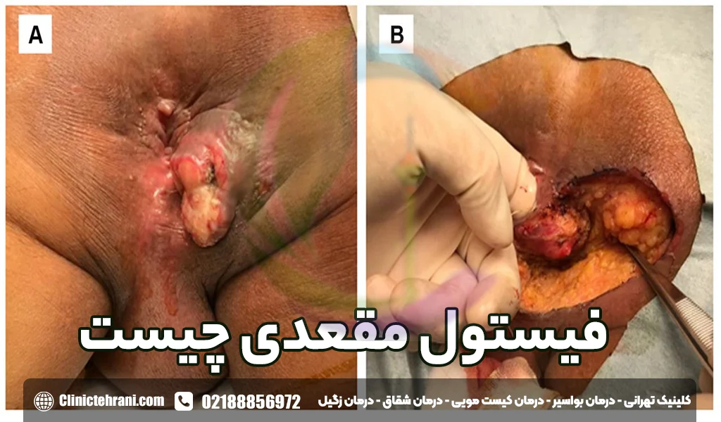 فیستول مقعدی چیست