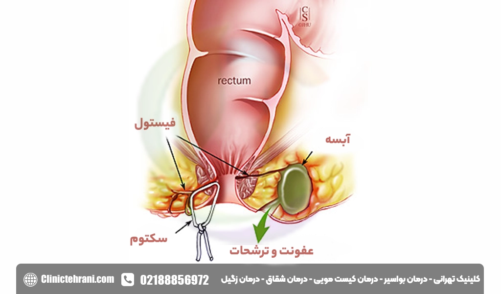 فیستول چیست