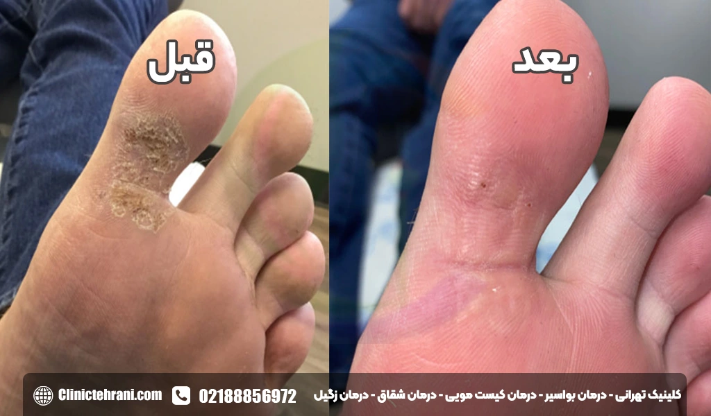 قبل و بعد لیزر زگیل تناسلی