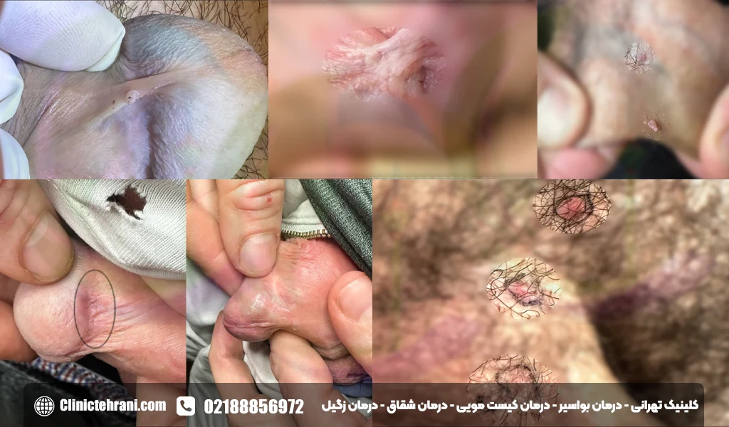 لیزر زگیل تناسلی