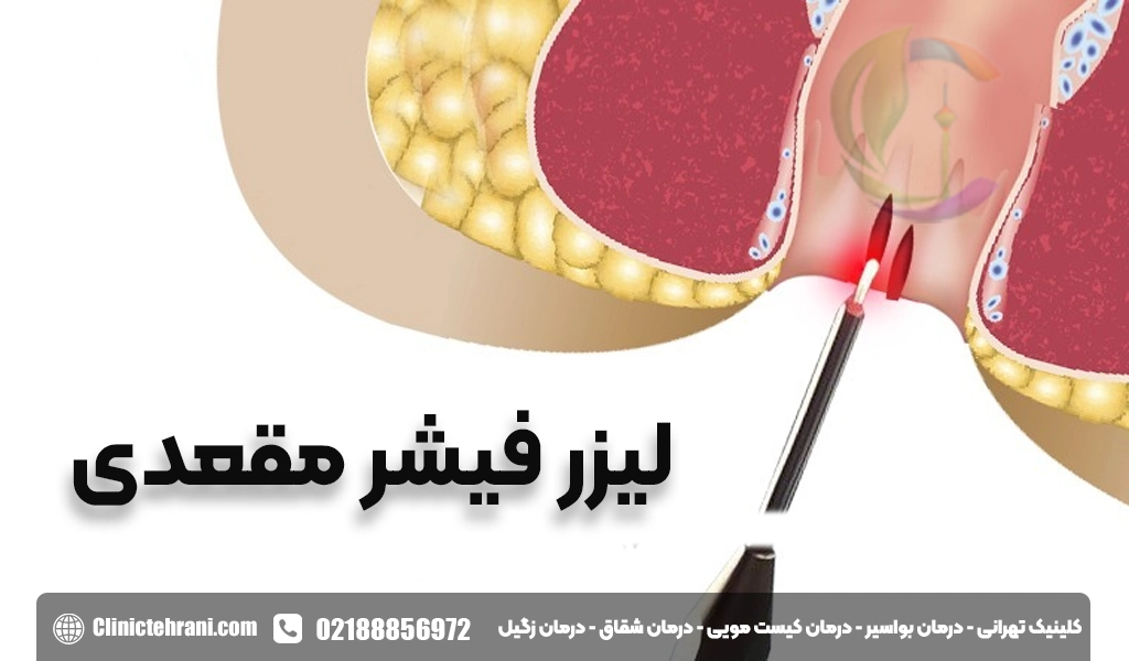 لیزر فیشر مقعدی