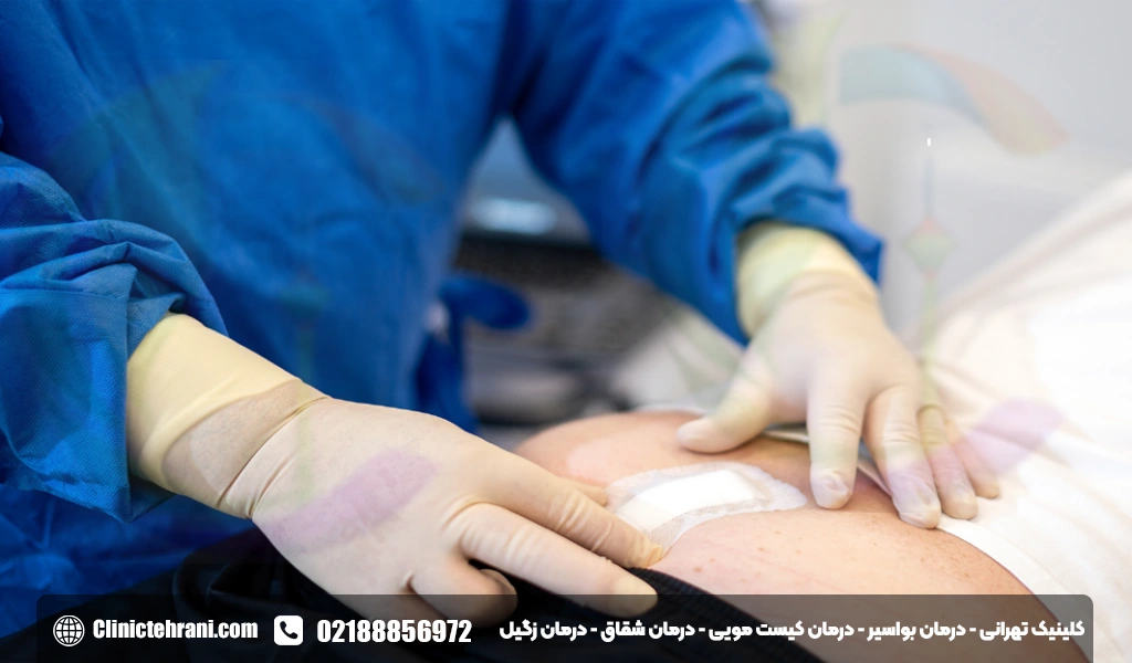 مدفوع بعد از عمل کیست مویی