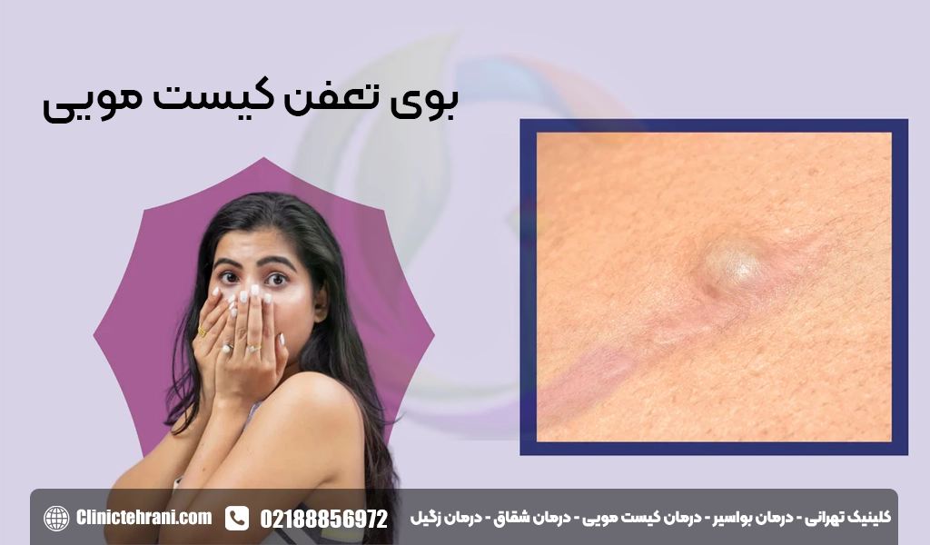 تشخیص سینوس مویی