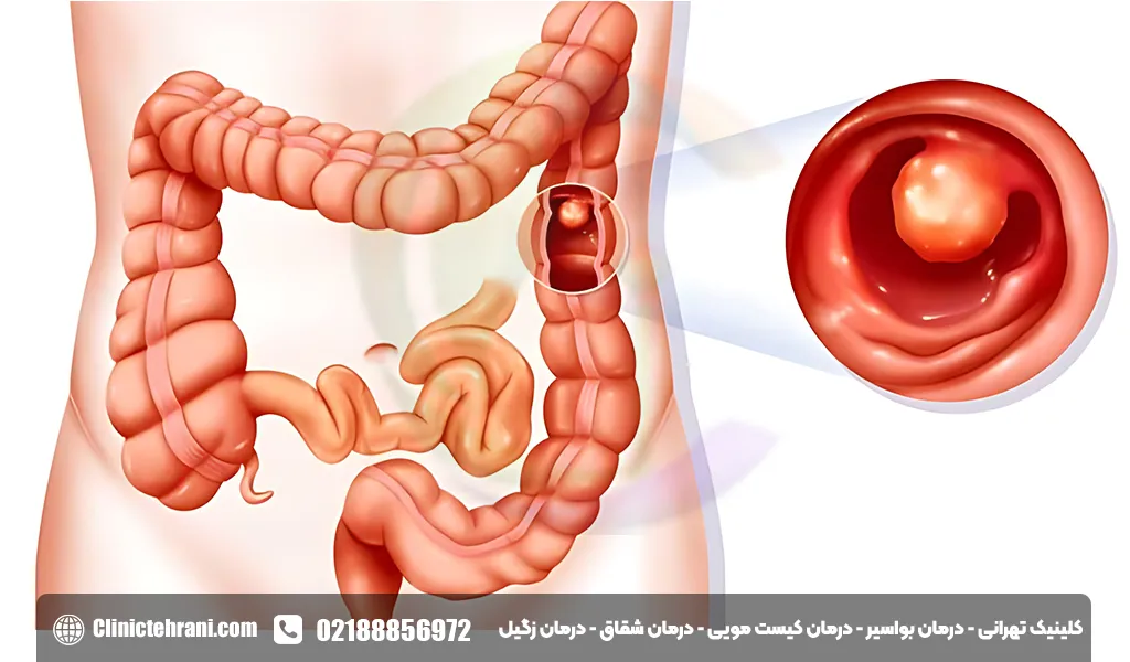 پولیپ رکتوم چیست