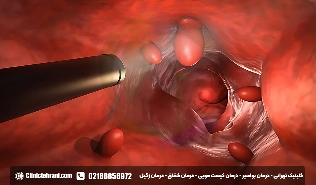 جراحی پولیپ روده