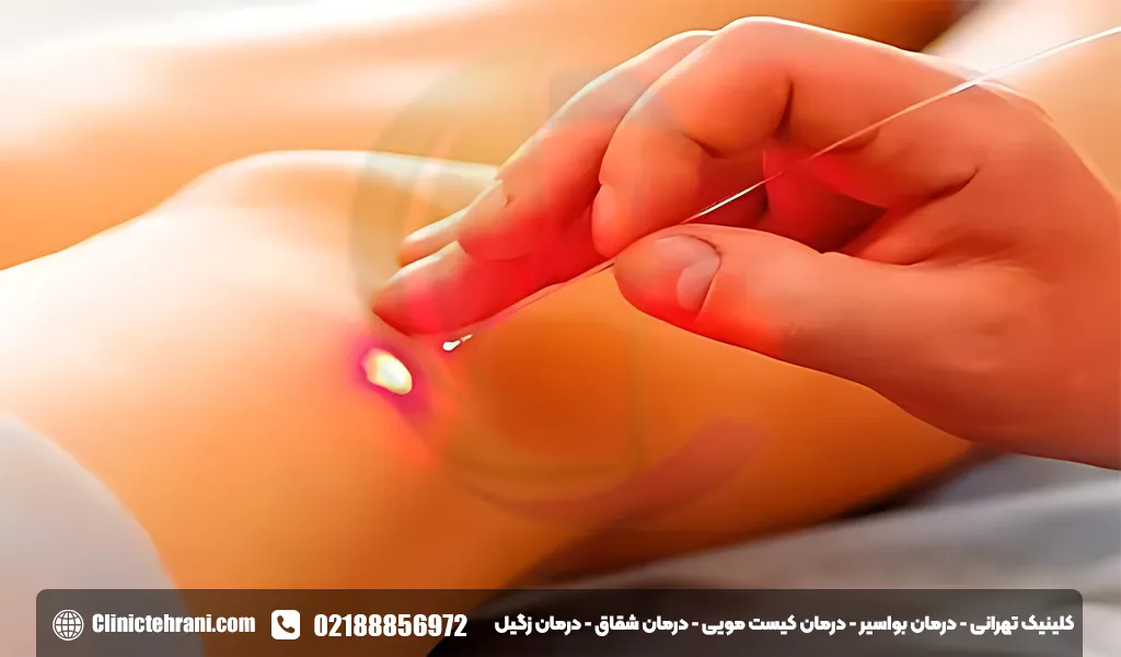 عمل مو برگشتی با لیزر