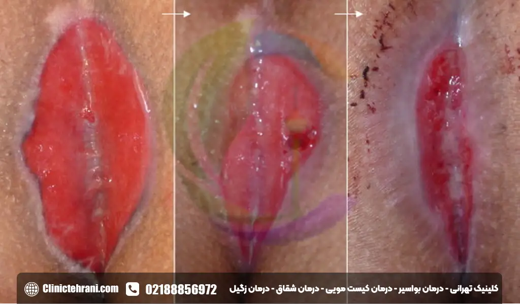 عمل کیست مویی باز