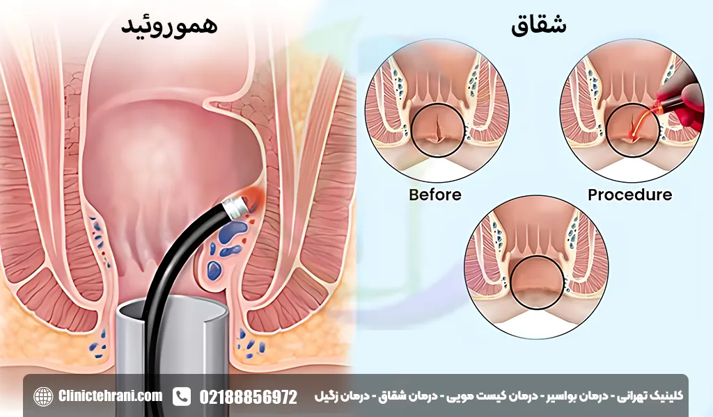 فرق شقاق و بواسیر