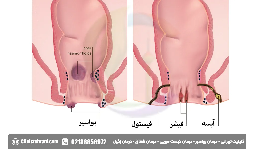 عکس شقاق و بواسیر