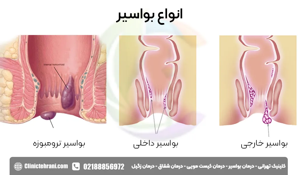 انواع بواسیر