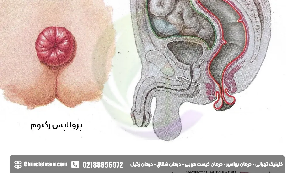 بواسیر درجه 4