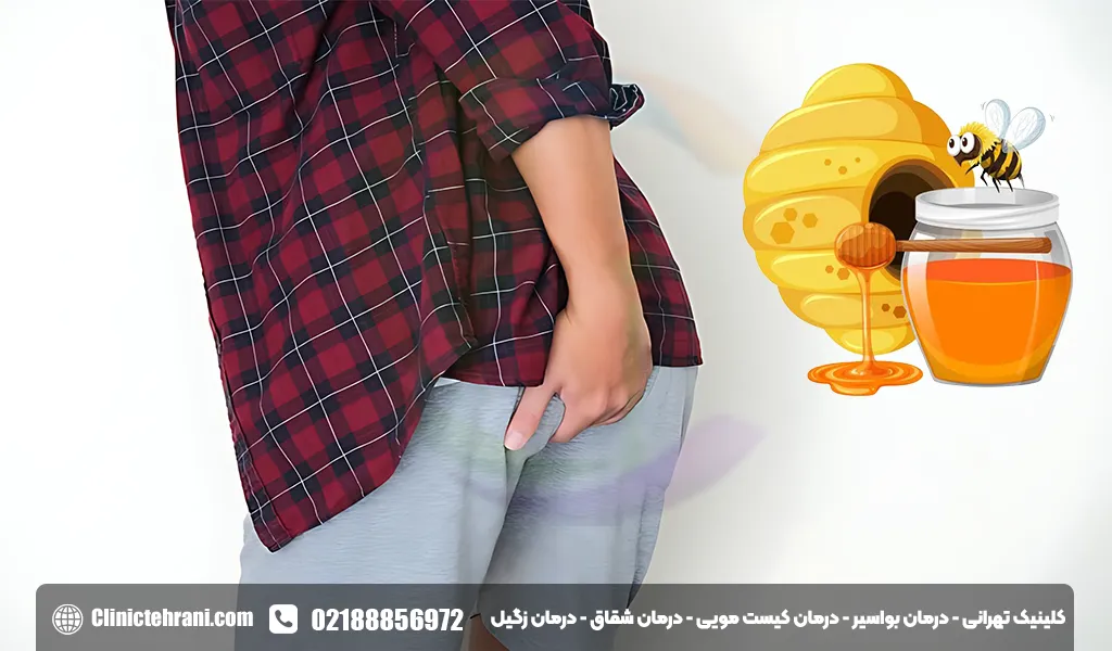 درمان شقاق با عسل