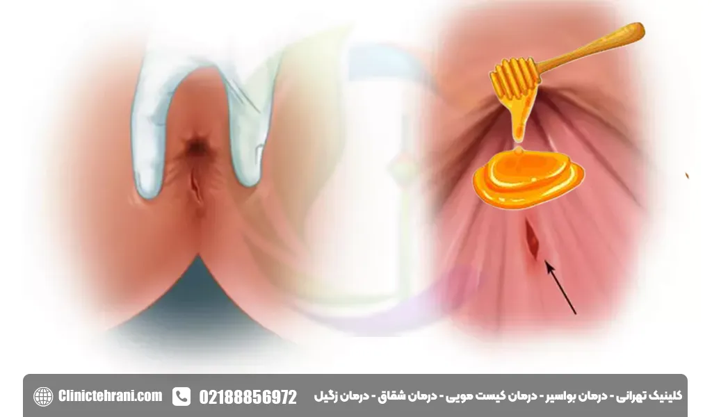 معجزه درمان شقاق