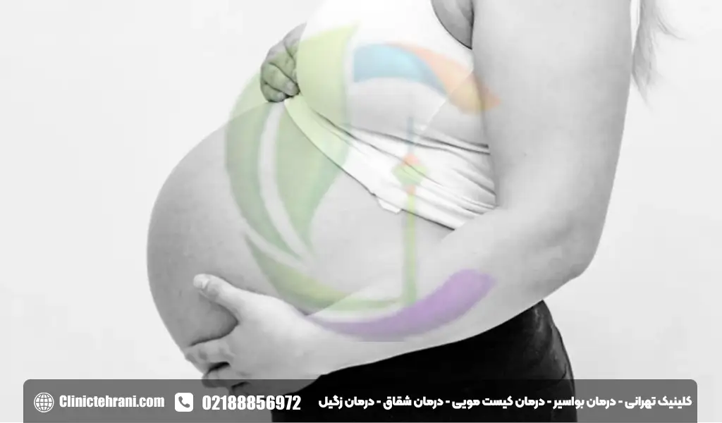علت بیرون زدگی مقعدی در بارداری
