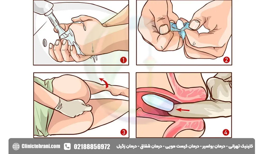 نحوه استفاده از شیاف بیزاکودیل
