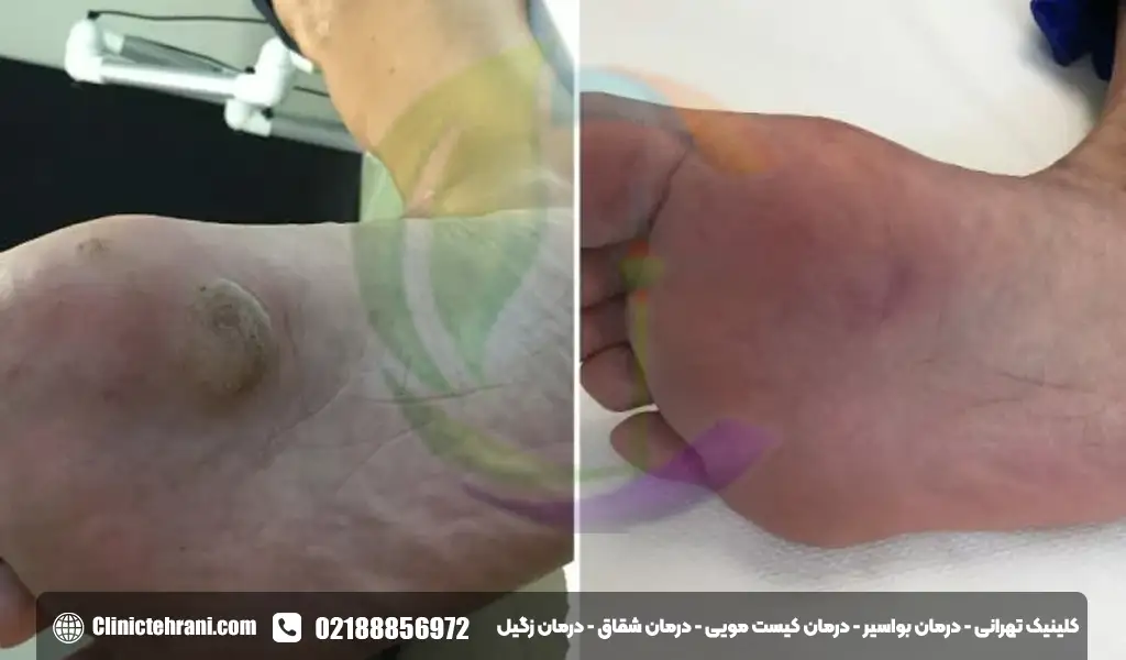 جای زگیل تناسلی بعد از لیزر