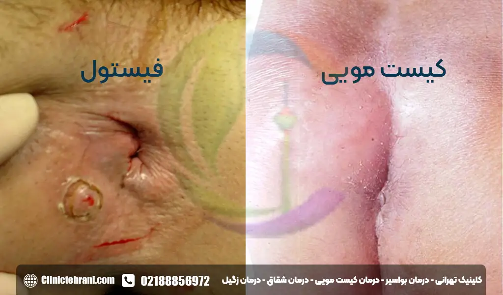 تفاوت کیست مویی و فیستول مقعدی در علائم