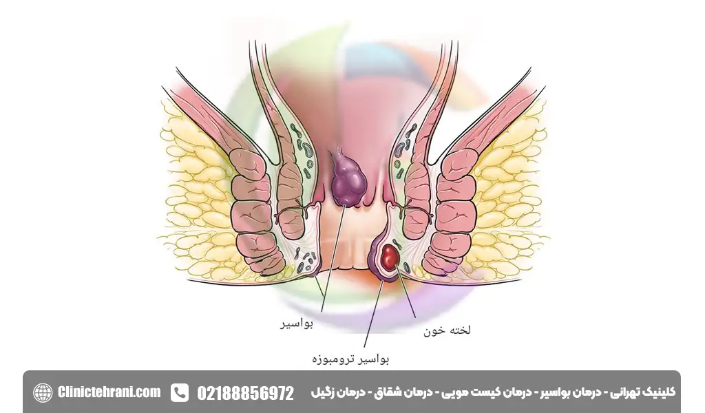 عکس هموروئید ترومبوزه