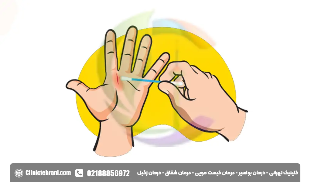 نحوه استفاده از بتادین برای زخم‌ 