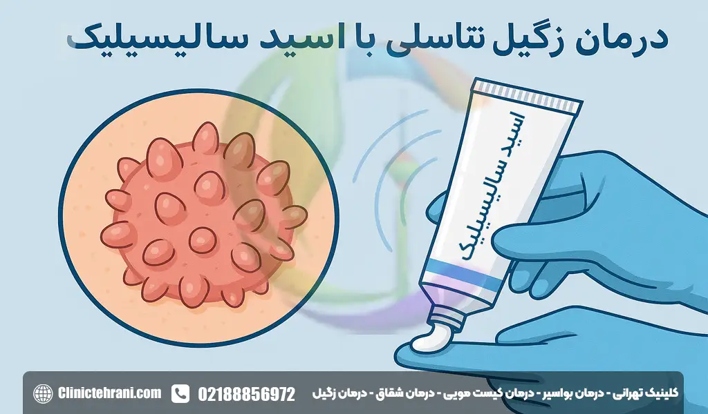 اسید سالیسیلیک برای زگیل تناسلی