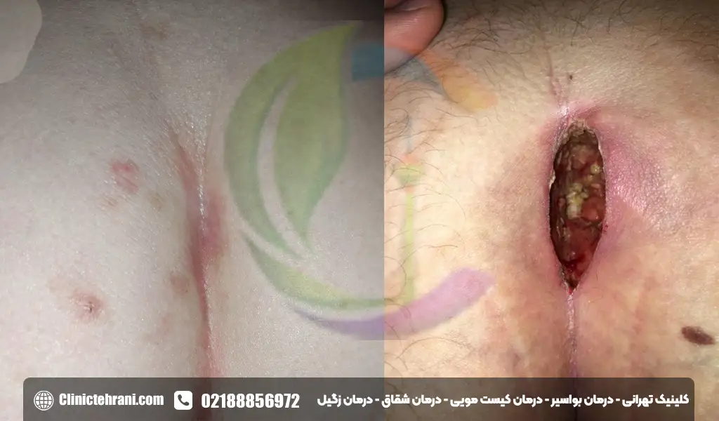 تعویض پانسمان کیست مویی در منزل
