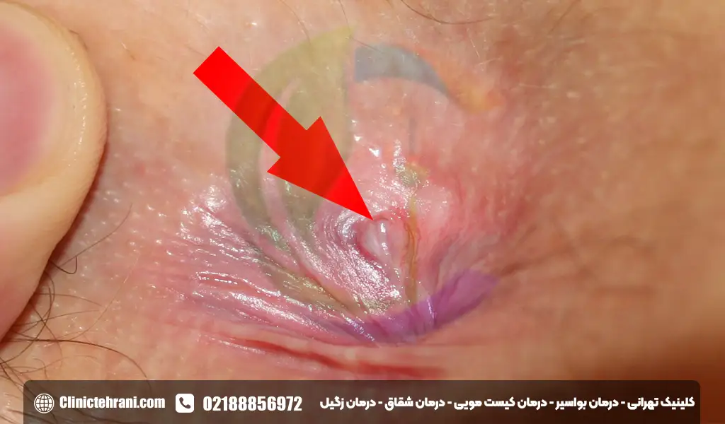 انواع شقاق