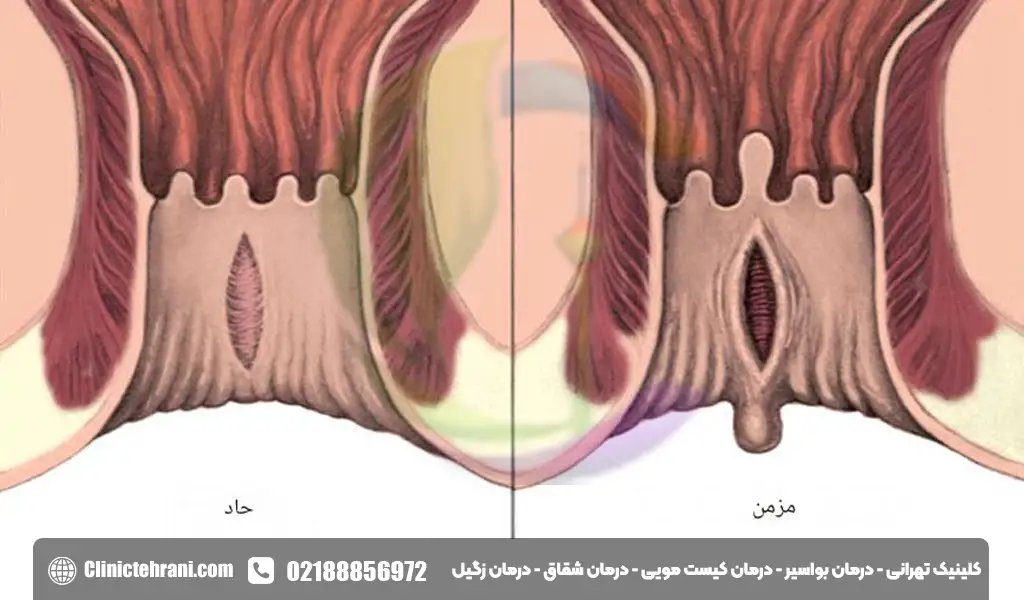 انواع شقاق مقعدی