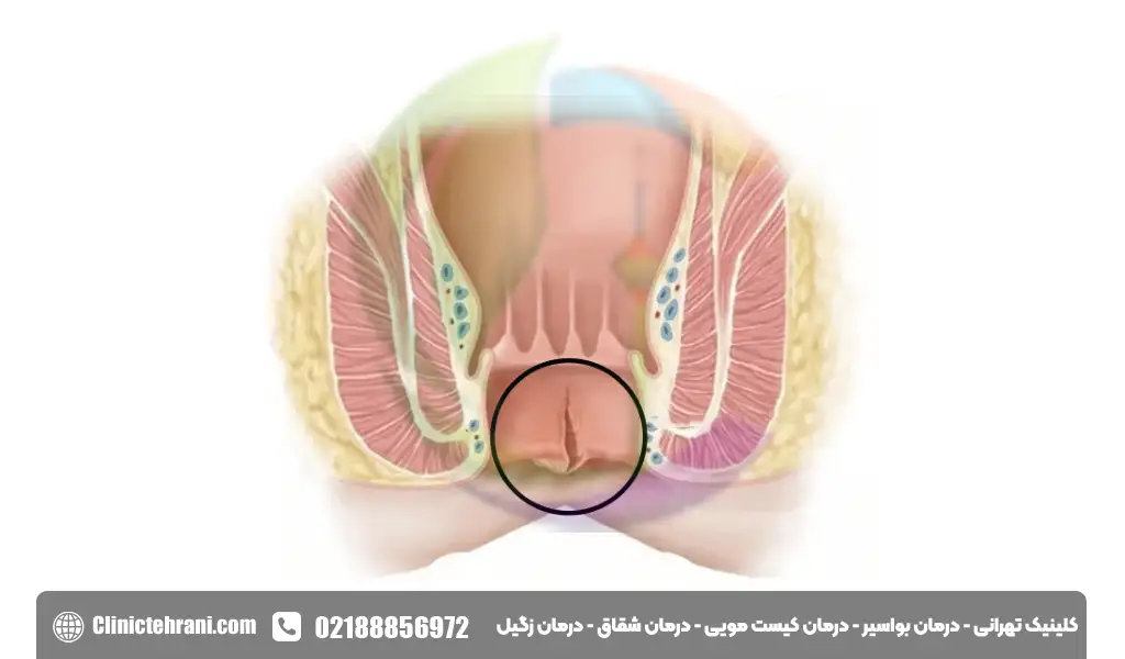 شقاق مقعدی چیست