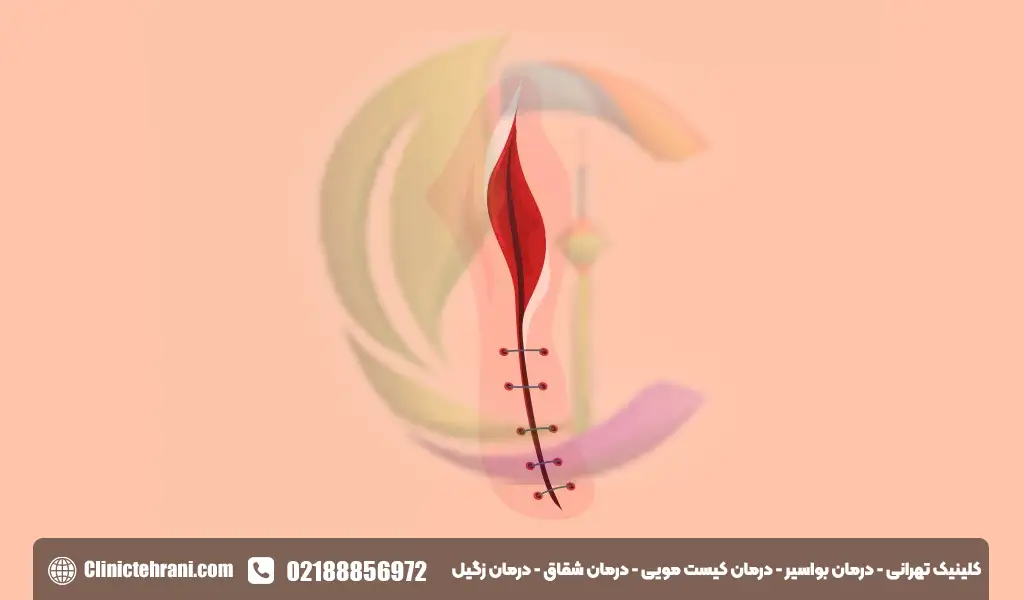 عوارض درمان کیست مویی