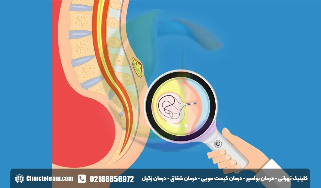 درمان کیست مویی
